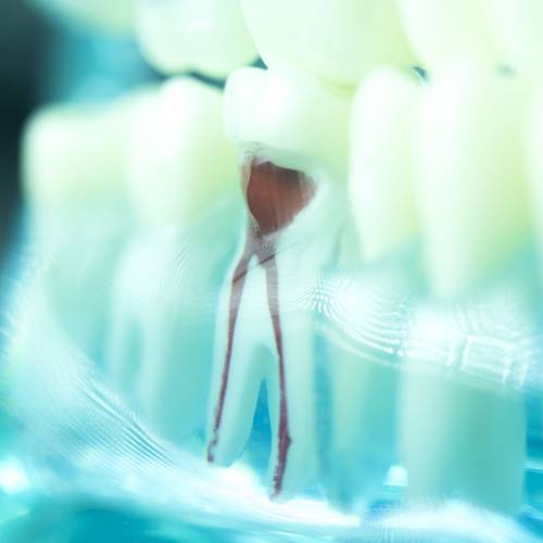 Root Canal Therapy Image